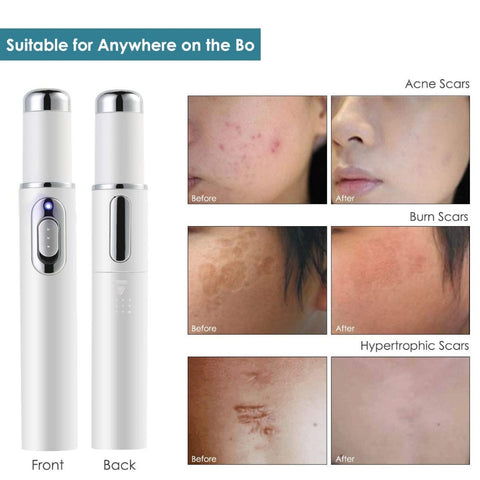 Blue Light Therapy Acne Laser Pen